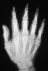 photo of an xray of a hand